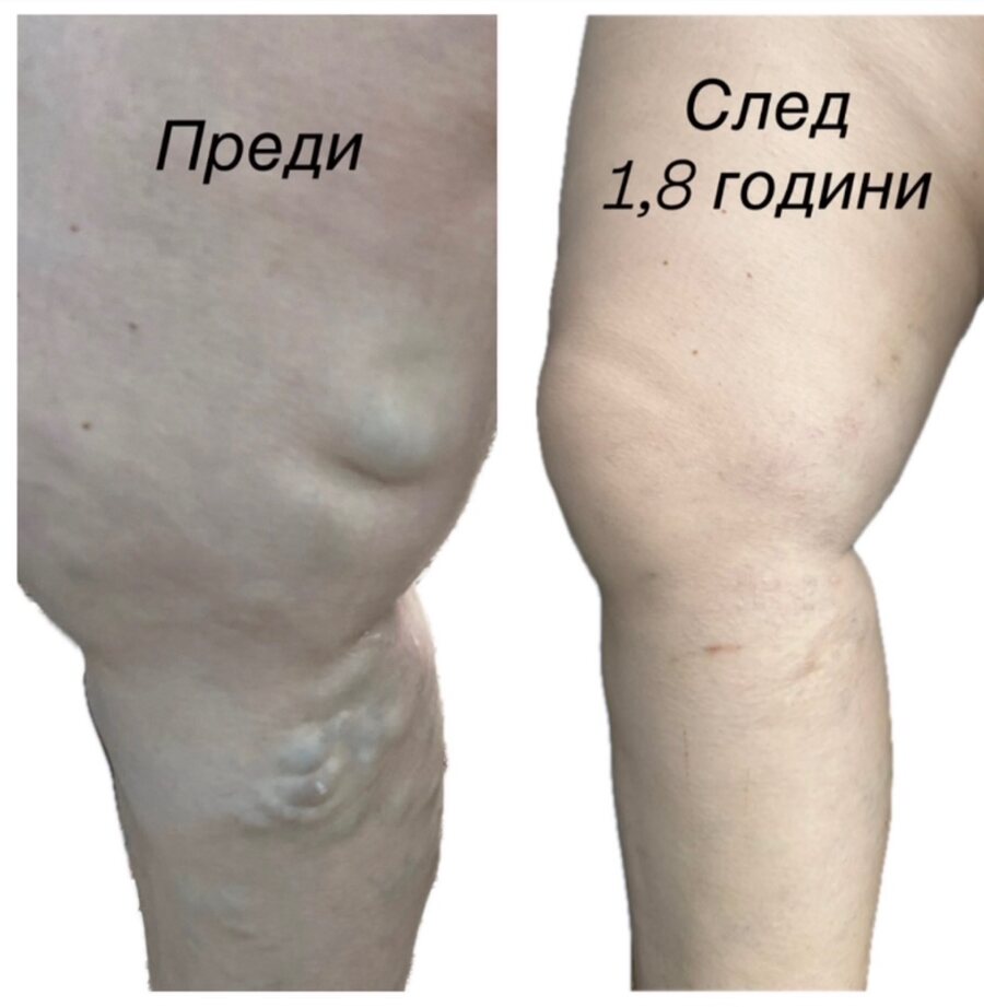 Клиничен случай — разширени вени