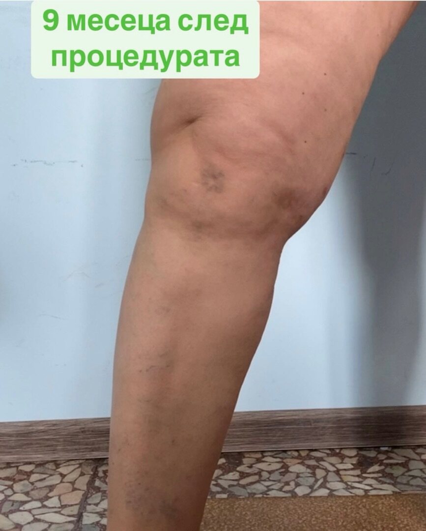 Клиничен случай — разширени вени